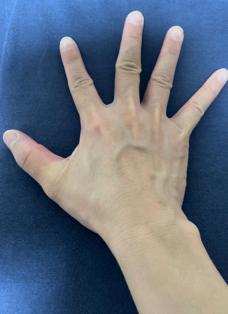 手掌肌肉：骨间肌的伸展